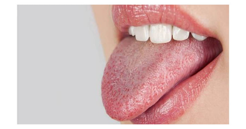 تشخیص بیماری از روی زبان